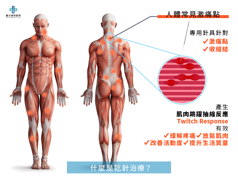 乾針治療針對激痛點