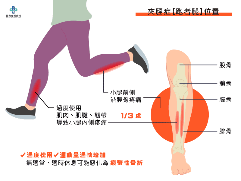 夾脛症跑者腿位置