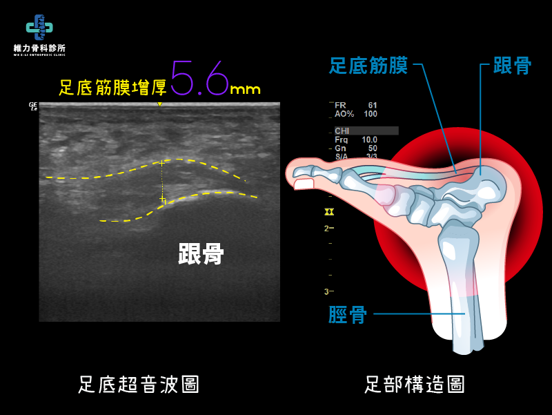 足底筋膜增厚確診足底筋膜炎