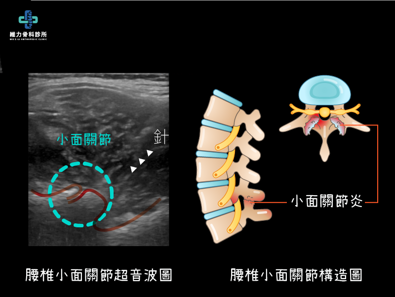 小面關節構造與超音波圖