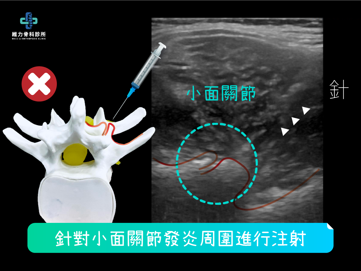 PRP自體血小板注射，腰椎小面關節超音波圖