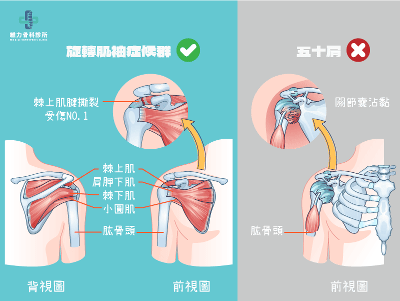 旋轉肌與五十肩的差別