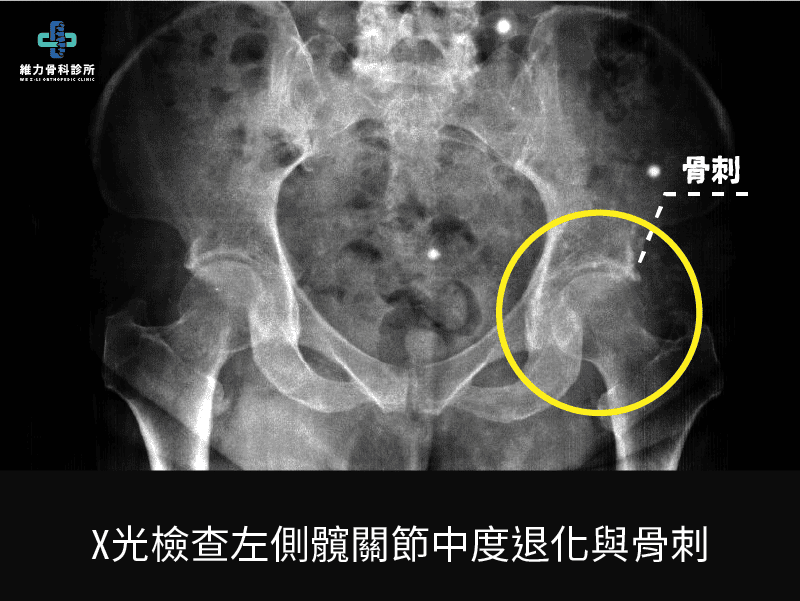 X光檢查髖關節中度退化與骨刺