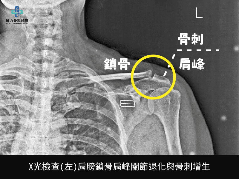 肩峰鎖骨關節退化骨刺增生