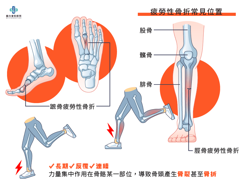 疲勞性骨折位置