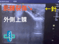 網球肘.gif 網球肘血小板注射