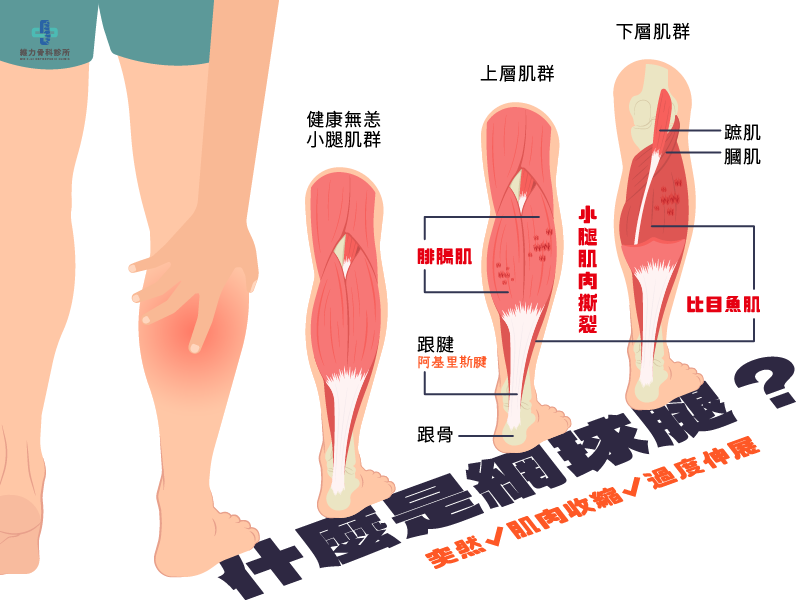 什麼是網球腿