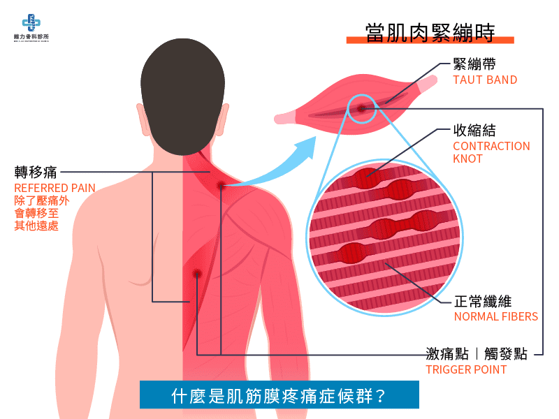 什麼是肌筋膜疼痛症候群