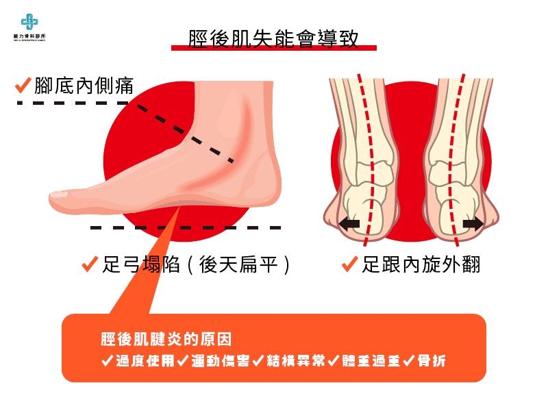 脛後肌腱炎症狀