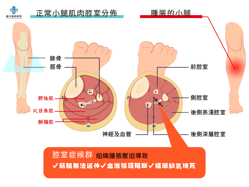 什麼是腔室症候群