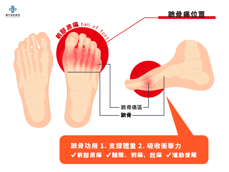 蹠骨痛症狀