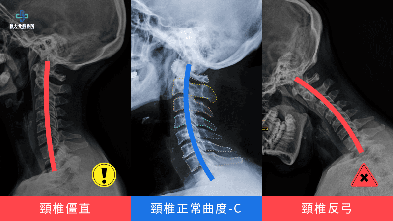 頸椎的正常曲線與頸椎僵直