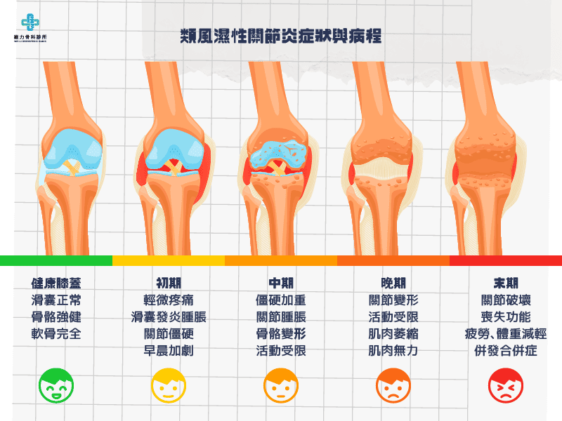 類風濕性關節炎症狀與病程