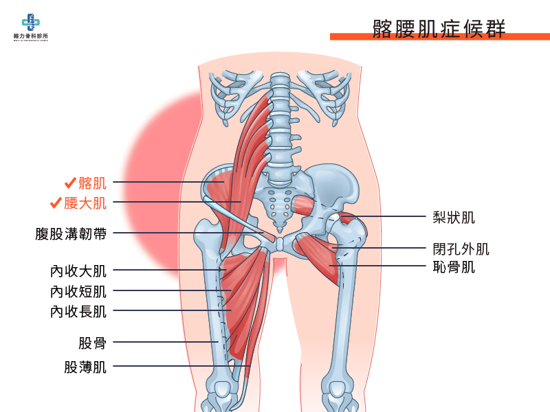 髂腰肌在哪裡