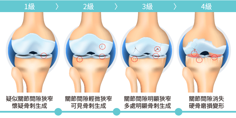 膝關節退化分級
