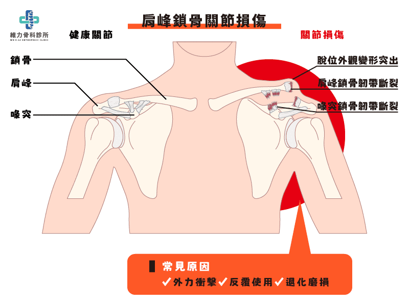 什麼是肩峰鎖骨關節損傷