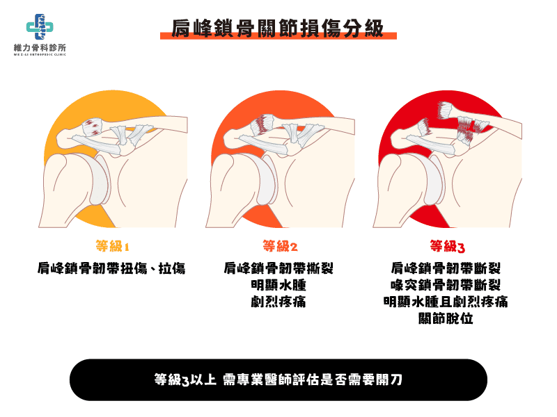 肩峰鎖骨關節損傷分級